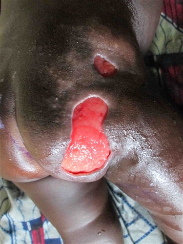 Wound abcess